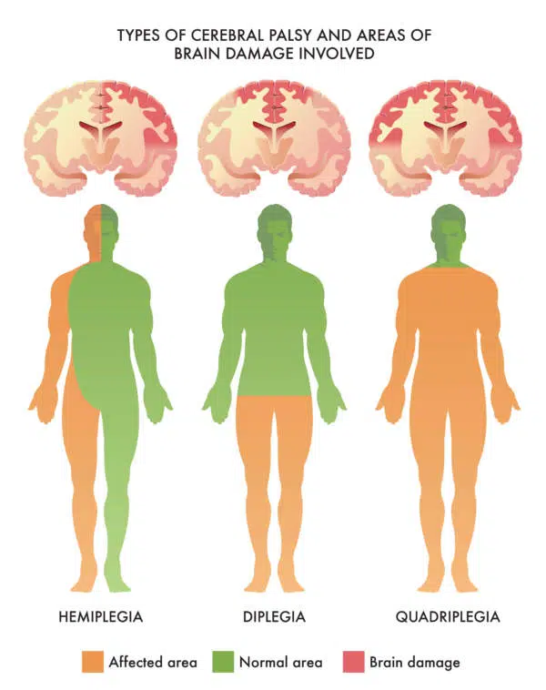 Was ist eine Infantile Cerebralparese?